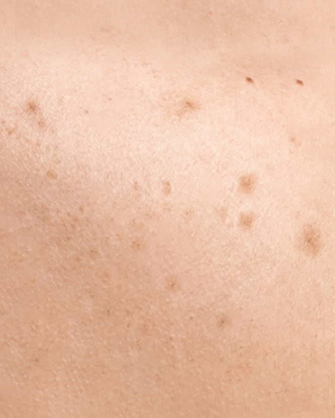 Dark Spots