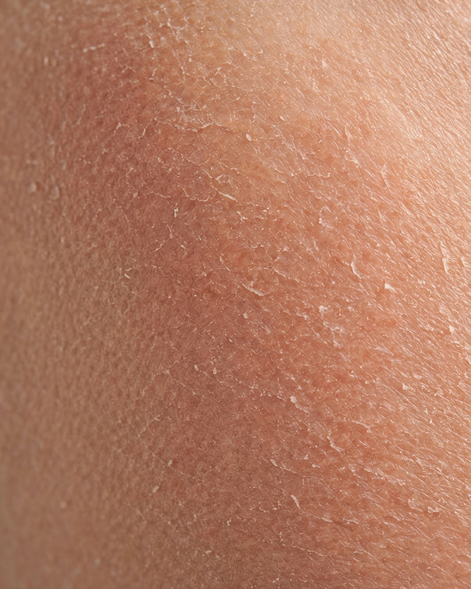 Dehydrated Skin