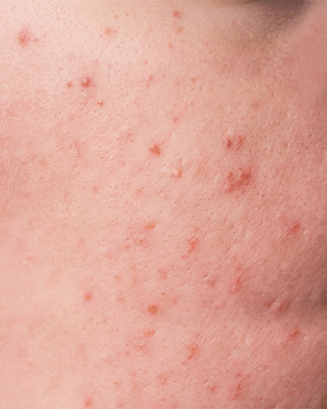 Sensitive Skin